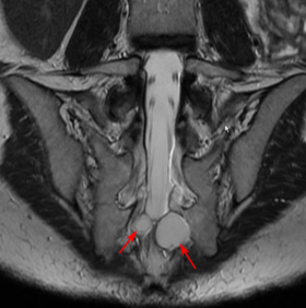 MRI image of Tarlov Cysts