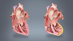 Myocardial Infarction, Heart Cross-Section