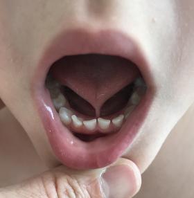 Tongue Tie